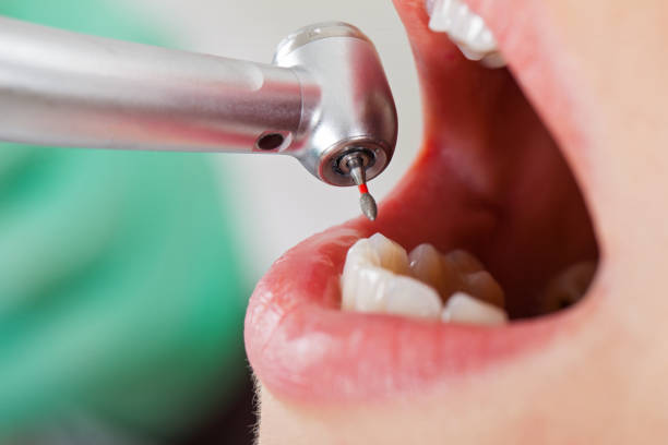 Best Emergency Root Canal Treatment in Chandler, IN